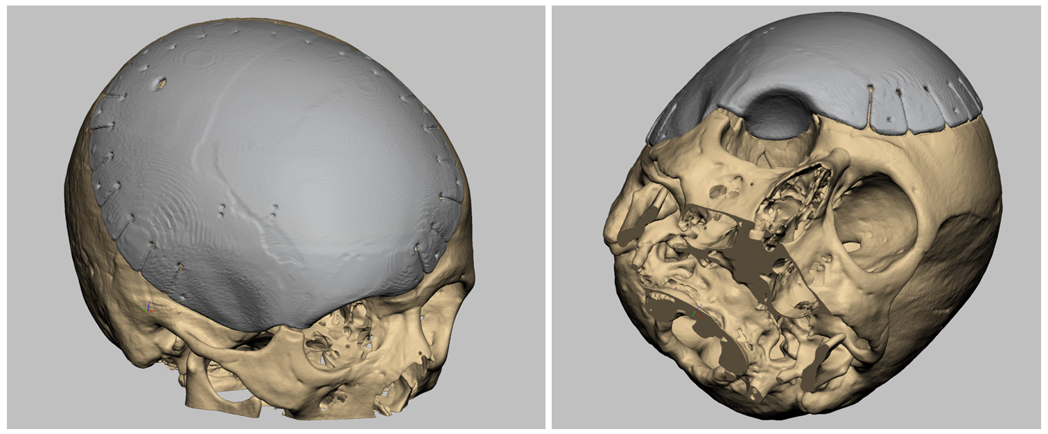 Cranio-orbital reconstruction images