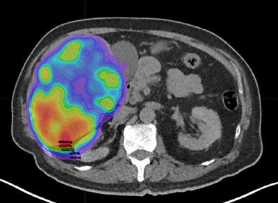 liver dose map